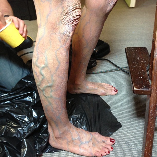 heidi-klum-veracose-veins