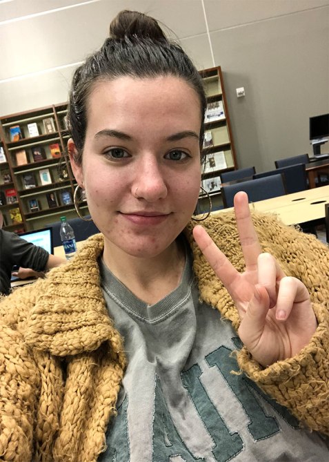 STYLECASTER | Learning to Love My Acne-Prone Skin