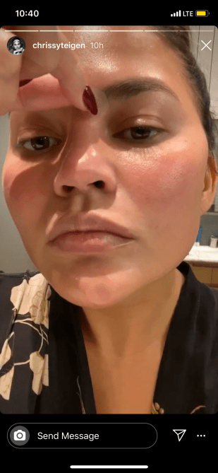 chrissy teigen zitsticka