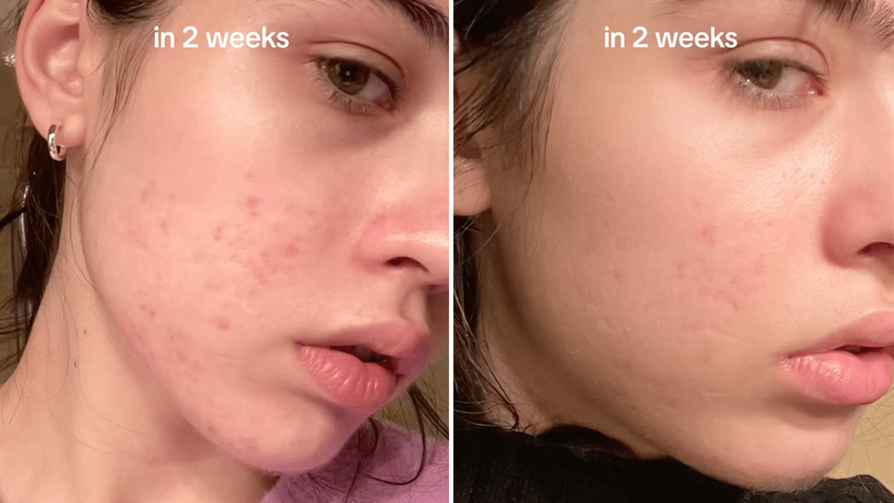 @tetka_beauty on TikTok showing the before and after of using Anua's 10% Niacinamide + 4% Tranexamic Acid Dark Spot Correcting Serum for two weeks. The before is on the left side and the after is on the right side.